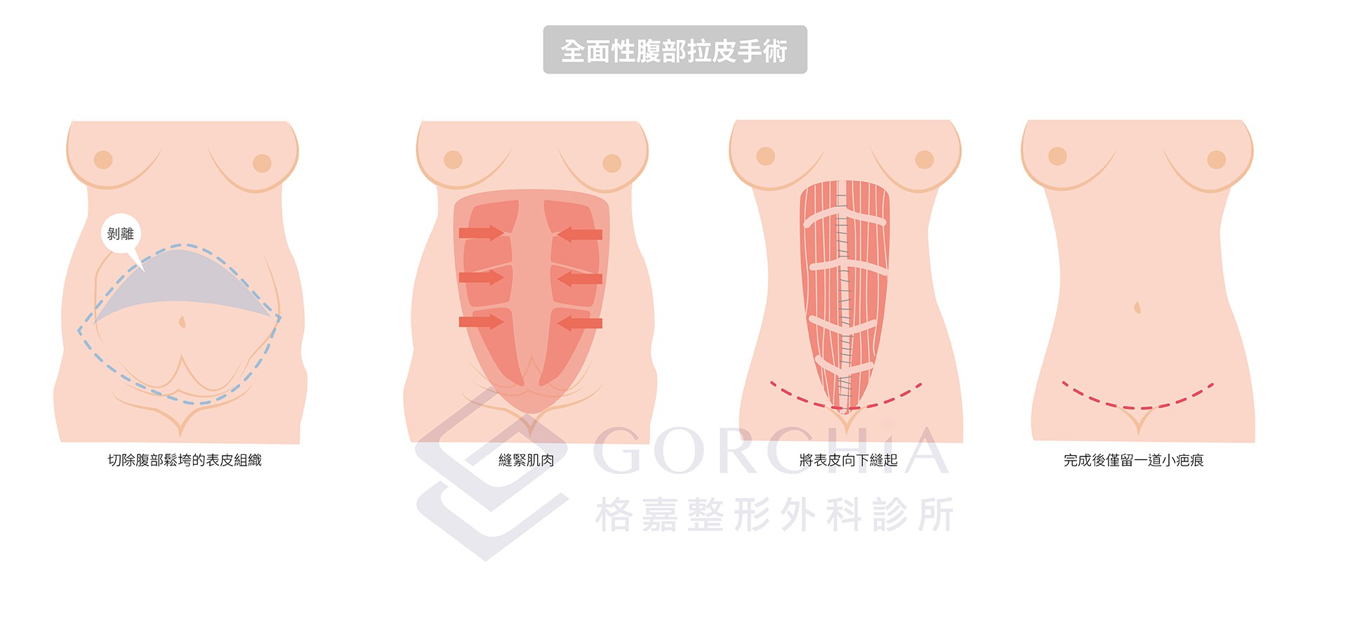 腹部拉皮手術過程
